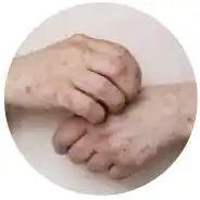 Obat Sipilis